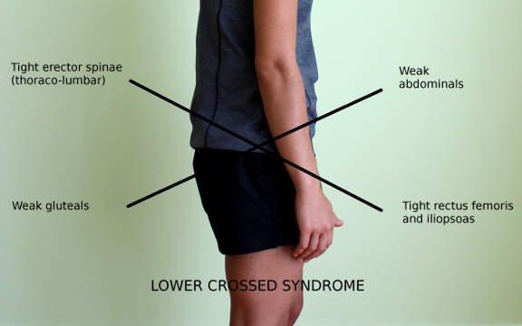 Common Muscle Imbalances: Upper Crossed Syndrome & Lower Crossed